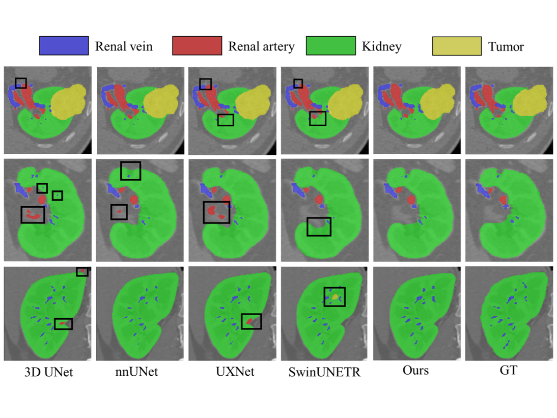 Shape Prior Enhanced U-Net Model for Medical Image Segmentation